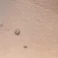 Skin Tags