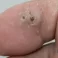 Warts