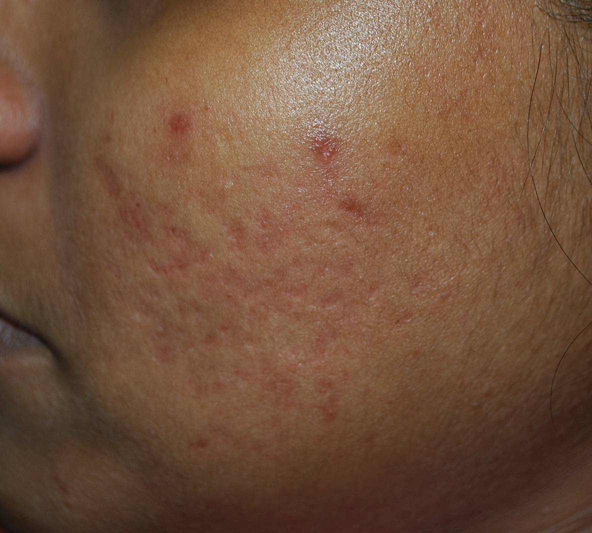 acne-after-v01