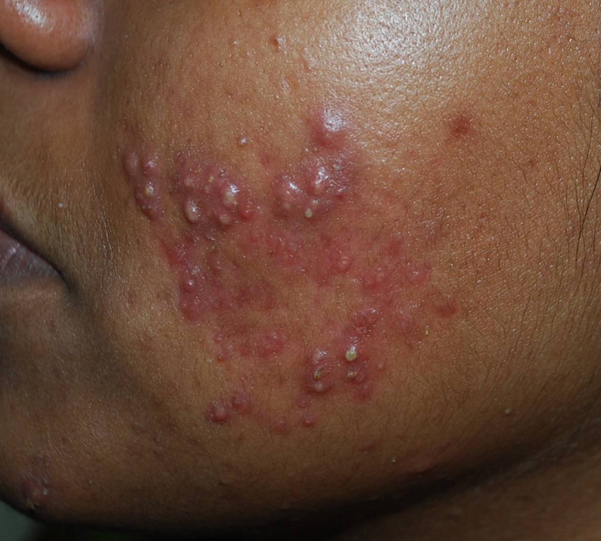 acne-before-v01