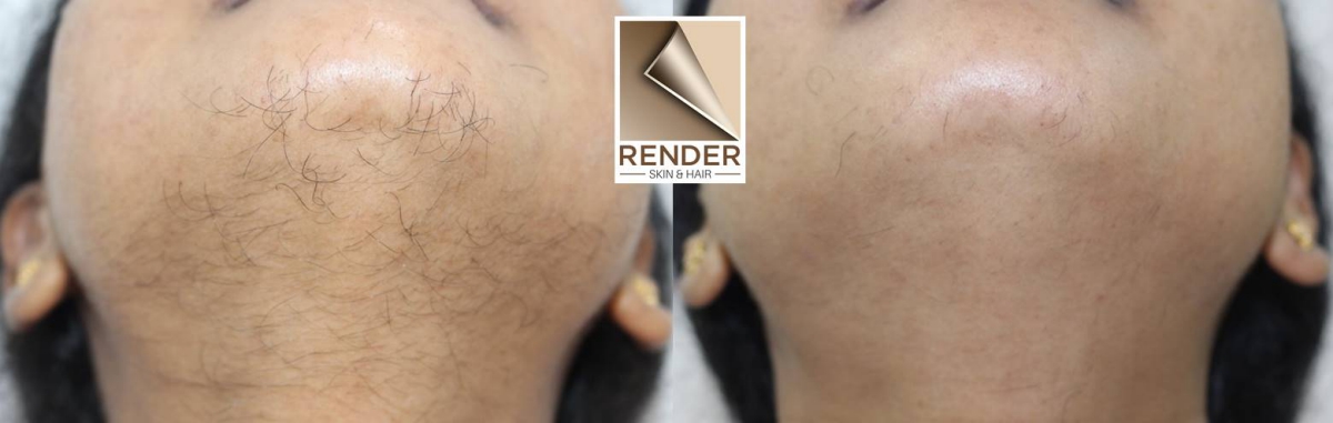 Excessive Body Hair - Best Skin and Hair Clinic In Chennai - Render Clinic