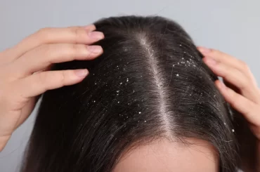 dandruff