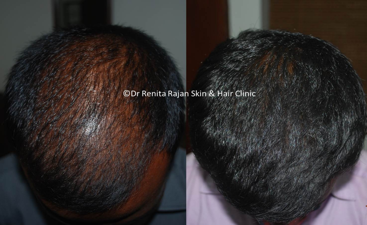 Hair Loss - Best Skin and Hair Clinic In Chennai - Render Clinic