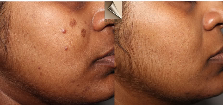image of a dark spot on the cheek, removed by pigment laser called Picoway