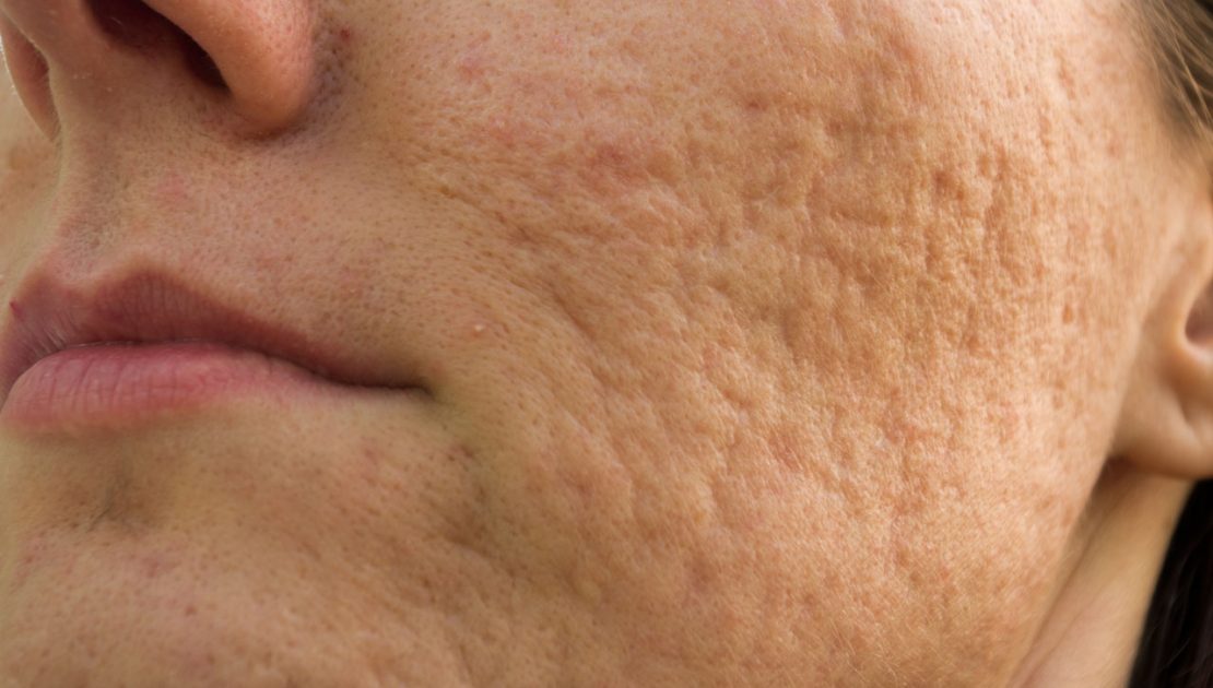 A woman with acne scars on the cheek