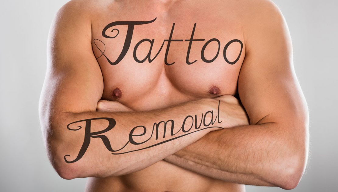 Image of a man showing the words "Tattoo /removal' written on his body