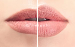 Image showing lips that have been enhanced with fillers - representational image