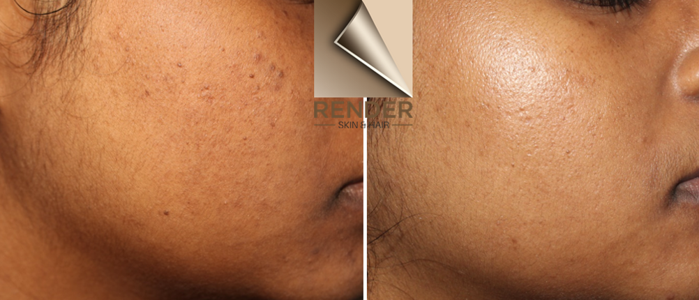 A picture of skin rejuvenation of the cheek, using Picoway done by Dr Renita Rajan