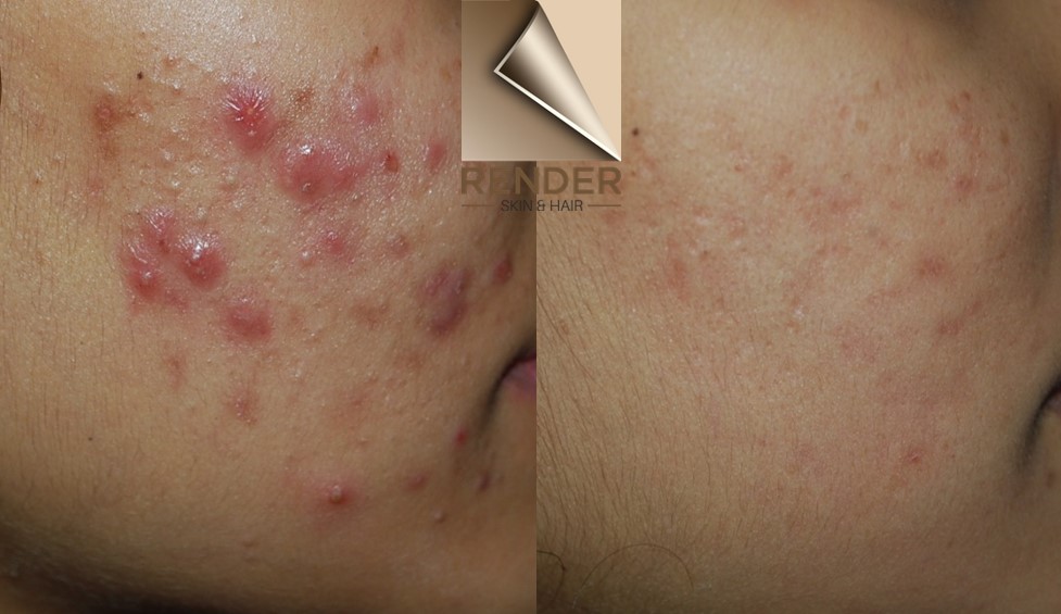 A person with acne on the cheek showing baseline image and results after treatment at RENDER clinic Dr Renita Rajan