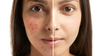 Acne on the right, clear on the left