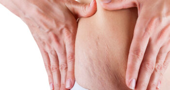 A woman showing her stretch marks on the hip