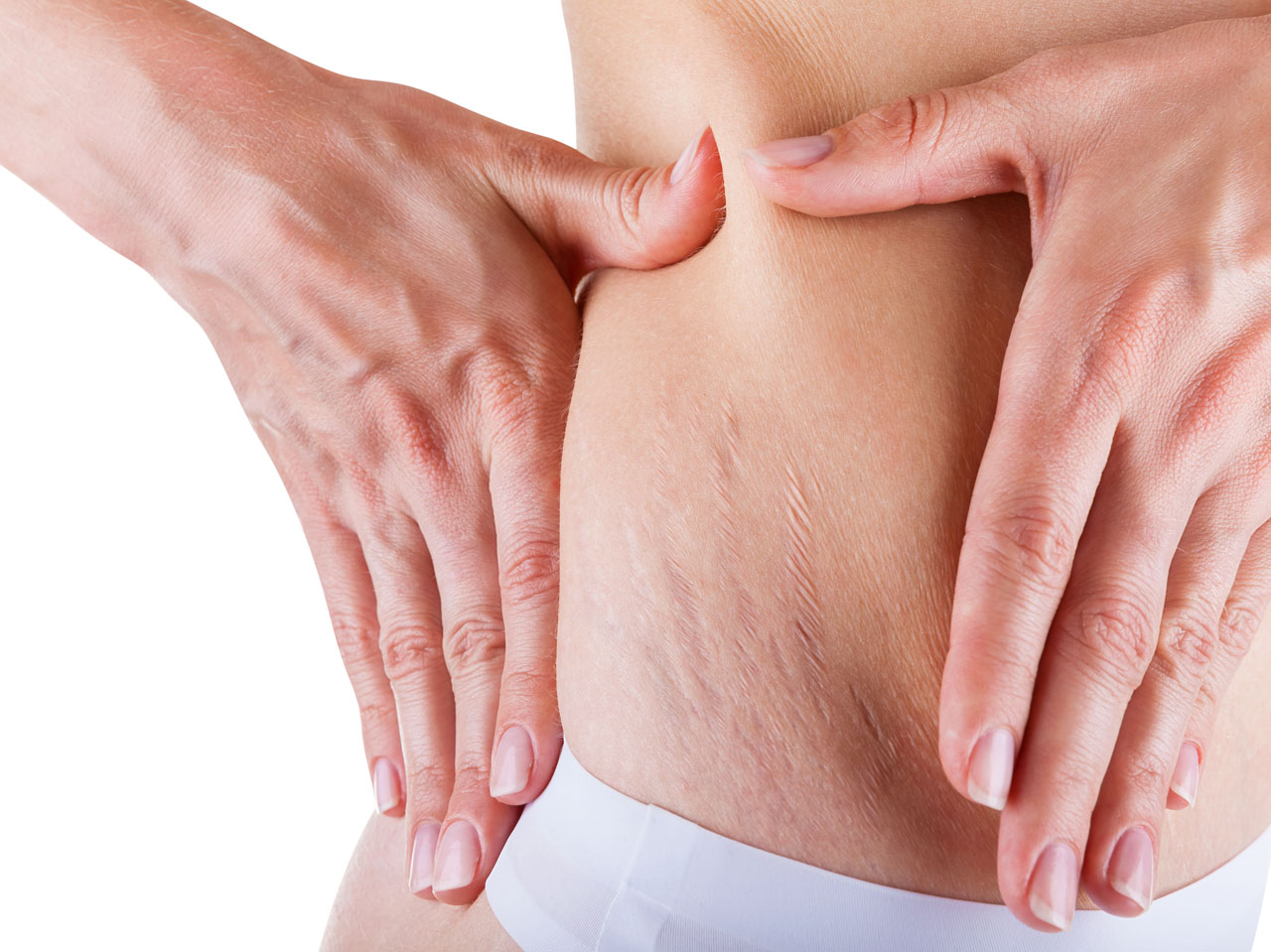 A woman showing her stretch marks on the hip