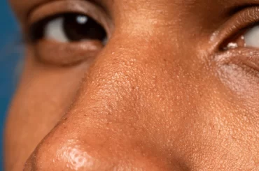open pores